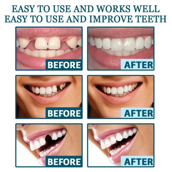 Adjustable Buckle Dentures - Image 7