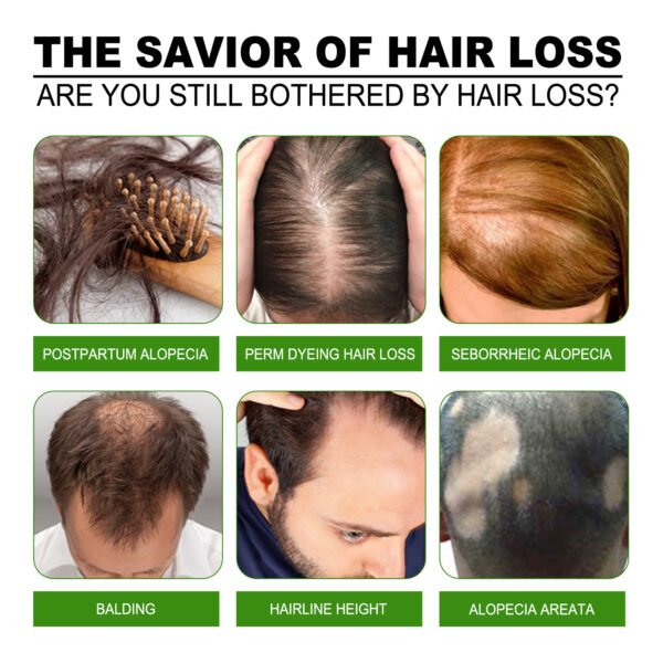Jaysuing Hair Treatment, Strengthens Hair, Nourishes Root Growth And Thickens Scalp Massage Nutrient Solution - Image 2